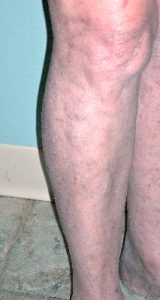70-year-old-female-after-treatment-for-varicose-veins-with-venefit-procedure
