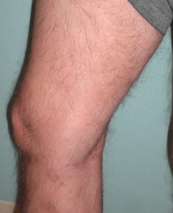 after Ablation, phlebectomy, sclerotherapy