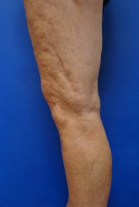 69 year old female after micro-phlebectomy and injection sclerotherapy