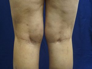 after radiofrequency ablation and sclerotherapy