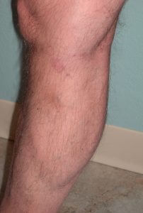 approximately 3 months after the last Ablation, phlebectomy, sclerotherapy