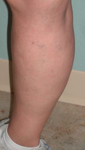 Cluster of varicose veins after sclerotherapy