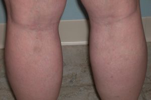 Sclerotherapy for varicose veins worked really well in this patient