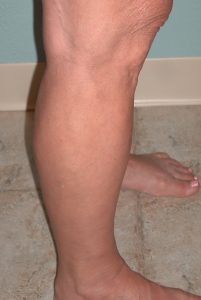 after varicose vein treatment