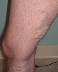 before Ablation, phlebectomy, sclerotherapy