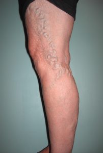 large varicose vein