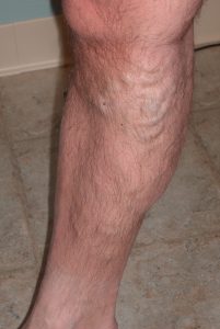 before closurefast, phlebectomy, sclerotherapy