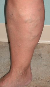 Cluster of varicose veins before and after sclerotherapy