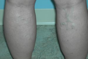 Sclerotherapy for varicose veins worked really well in this patient.
