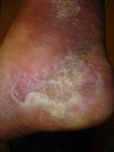 76 year old male diabetic with leg and ankle ulcer