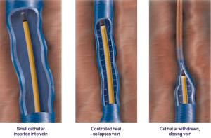 closurefast radio frequency ablation procedure