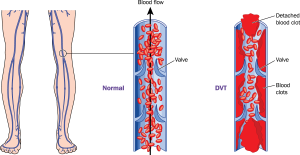 deep vein thrombosis