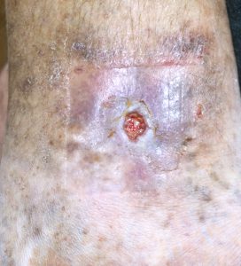 leg ulcer before treatment