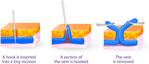 phlebectomy treatment