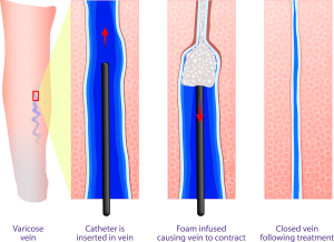 sclerotherapy treatment