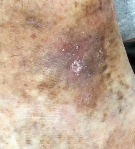 treatment leg ulcer after woung care compression therapy