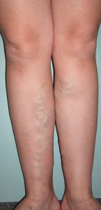 varicose veins keller texas