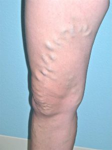 varicose veins on legs of 42 year old female before treatment