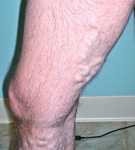 varicose veins on legs of 44 year old male before treatment
