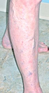 varicose-veins-on-legs-of-70-year-old-female-before-treatment