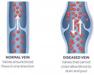 vein disease grapevine texas