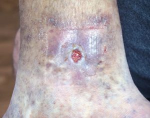 venous leg ulcers